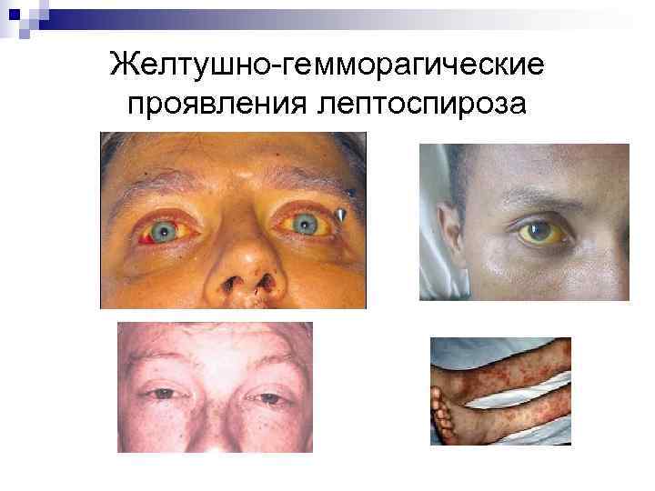 Желтушно-гемморагические проявления лептоспироза 