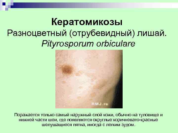     Кератомикозы Разноцветный (отрубевидный) лишай.   Pityrosporum orbiculare Поражается только