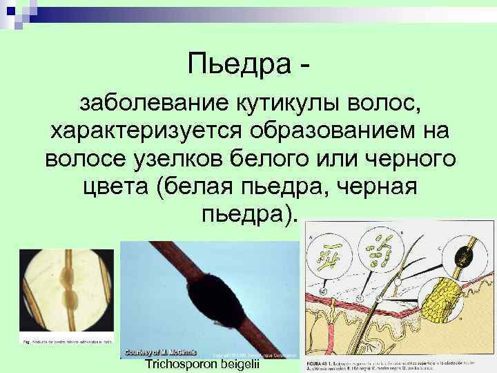     Пьедра -  заболевание кутикулы волос, характеризуется образованием на волосе