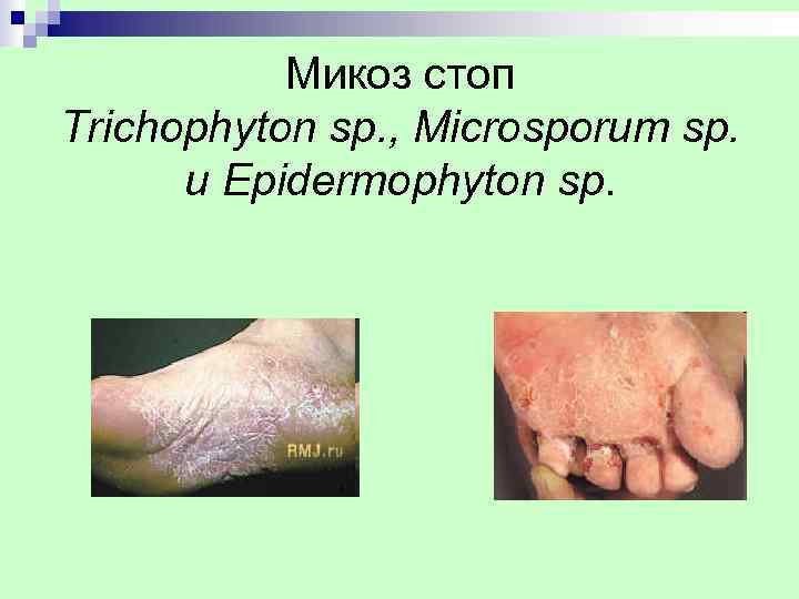   Микоз стоп Trichophyton sp. , Microsporum sp.  и Epidermophyton sp. 