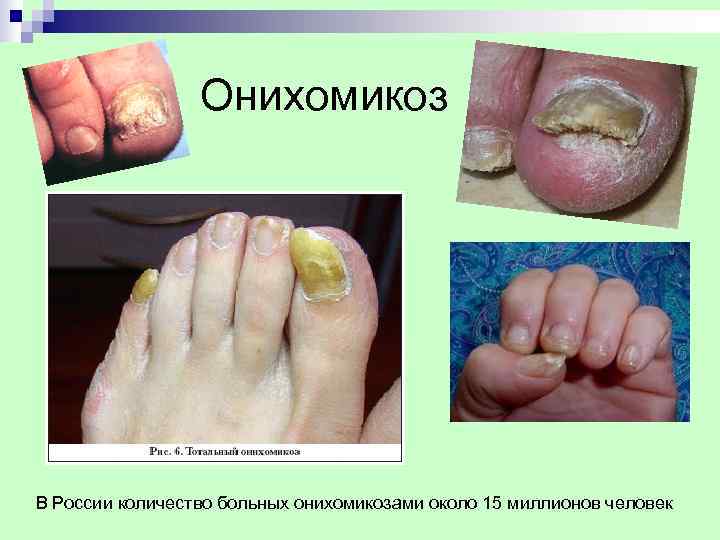   Oнихомикоз В России количество больных онихомикозами около 15 миллионов человек. 