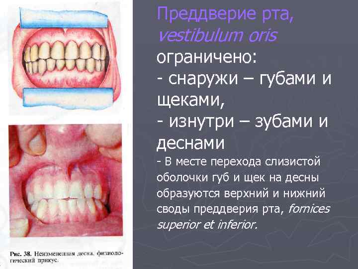 Преддверие рта, vestibulum oris ограничено: - снаружи – губами и щеками, - изнутри –