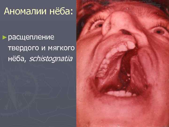 Аномалии нёба: ► расщепление твердого и мягкого нёба, schistognatia 