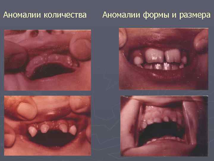 Аномалии количества Аномалии формы и размера 