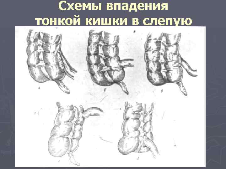 Схемы впадения тонкой кишки в слепую 