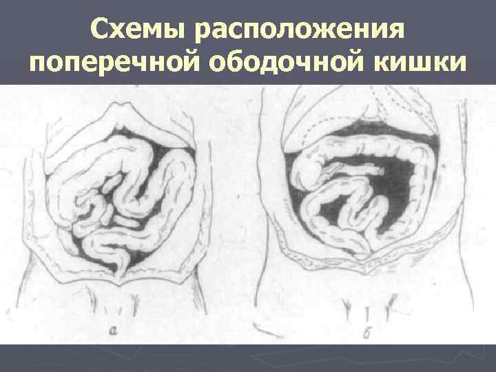 Схемы расположения поперечной ободочной кишки 