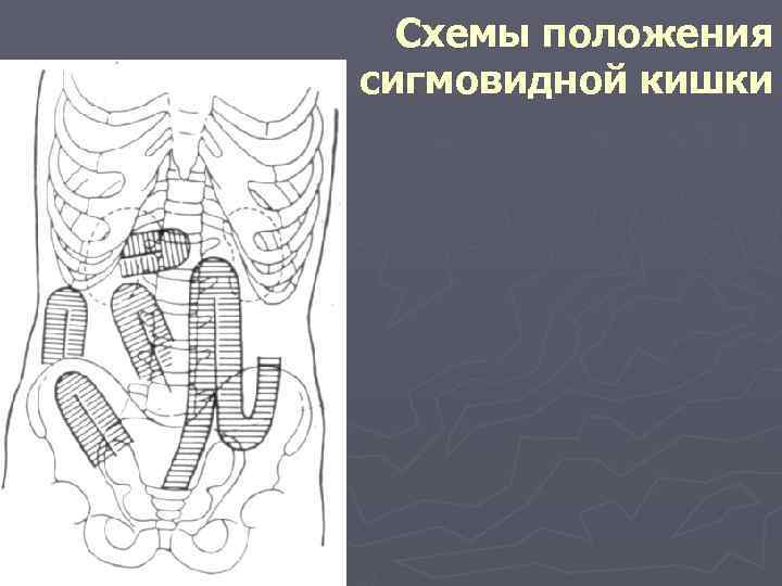 Схемы положения сигмовидной кишки 