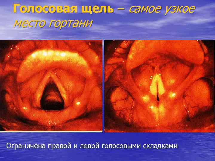 Голосовая щель – самое узкое место гортани Ограничена правой и левой голосовыми складками 