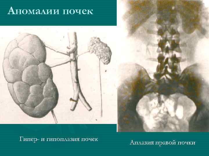 Аномалии почек Гипер- и гипоплазия почек Аплазия правой почки 