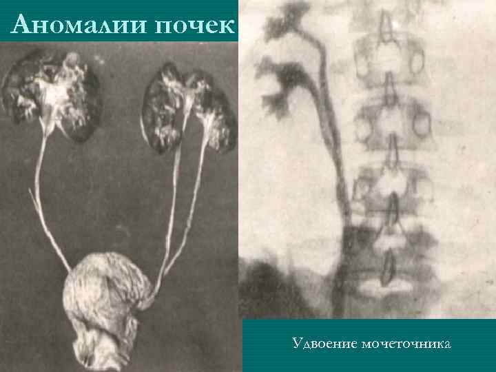 Аномалии почек Удвоение мочеточника 