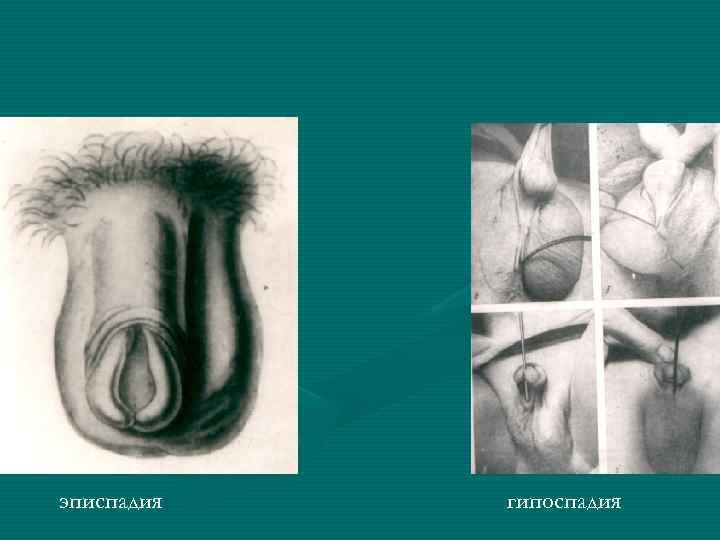эписпадия гипоспадия 