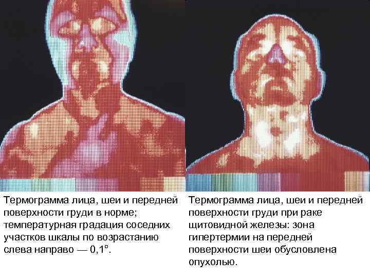 Термограмма лица, шеи и передней поверхности груди в норме; температурная градация соседних участков шкалы