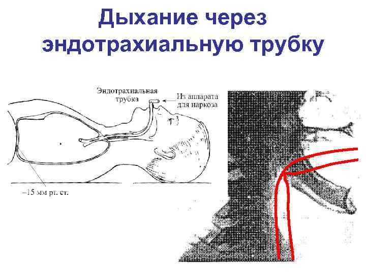 Дыхание через эндотрахиальную трубку 