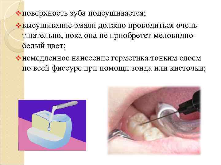 v поверхность зуба подсушивается; v высушивание эмали должно проводиться очень  тщательно, пока она