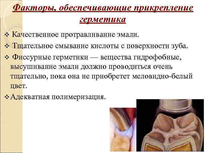   Факторы, обеспечивающие прикрепление   герметика v Качественное протравливание эмали. v Тщательное