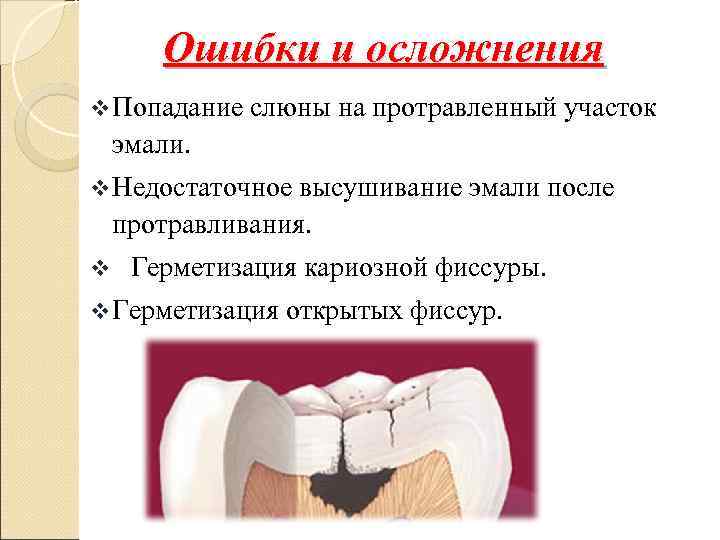   Ошибки и осложнения v Попадание  слюны на протравленный участок эмали. v