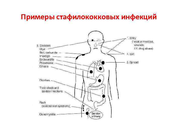 Примеры стафилококковых инфекций Примеры стафилококковых инфекций