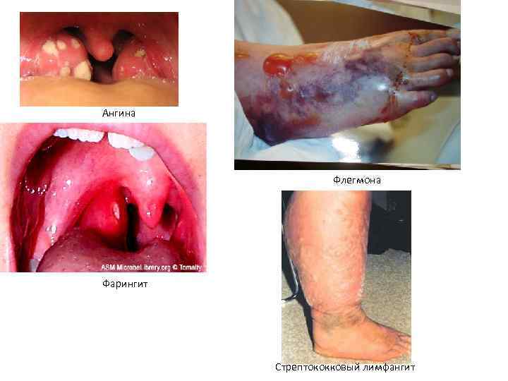 Ангина Флегмона Фарингит Стрептококковый лимфангит Ангина Флегмона Фарингит Стрептококковый лимфангит