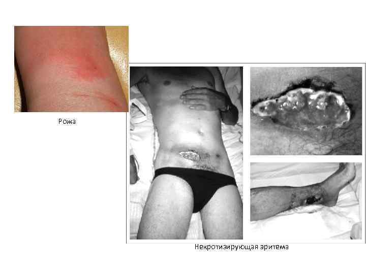 Рожа Некротизирующая эритема Рожа Некротизирующая эритема