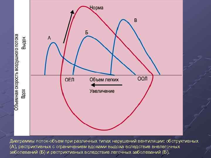 Диаграммы поток объем при различных типах нарушений вентиляции: обструктивных (А), рестриктивных с ограничением вдохами