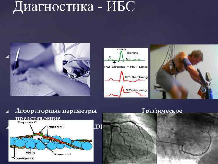 Диагностика - ИБС Анамнез Лабораторные параметры представление (тропонин I u. T, CK-MB, LDH ЭКГ