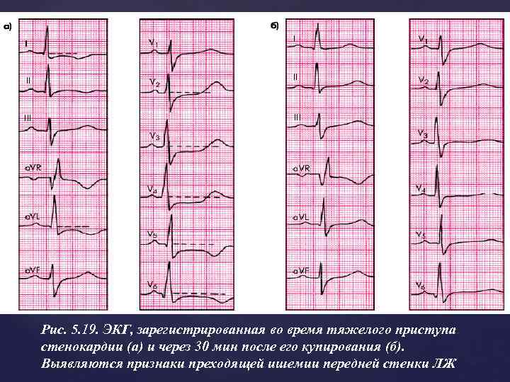Рис. 5. 19. ЭКГ, зарегистрированная во время тяжелого приступа стенокардии (а) и через 30