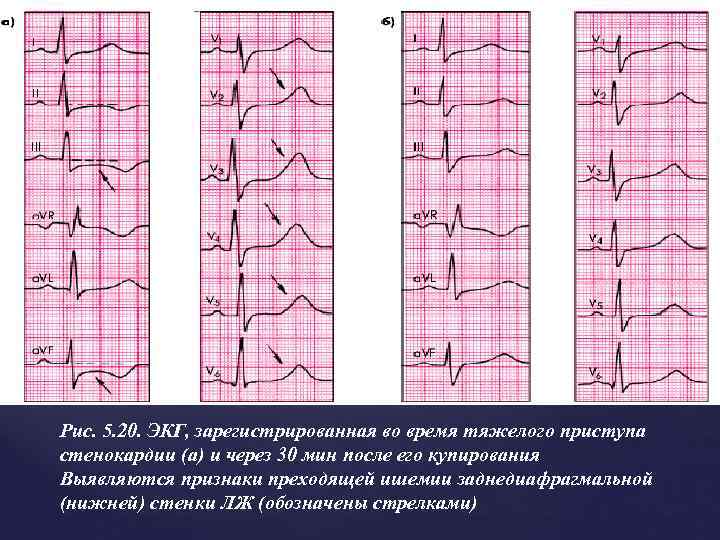 Рис. 5. 20. ЭКГ, зарегистрированная во время тяжелого приступа стенокардии (а) и через 30