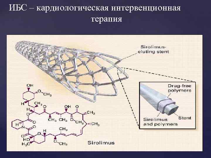 ИБС – кардиологическая интервенционная терапия { 