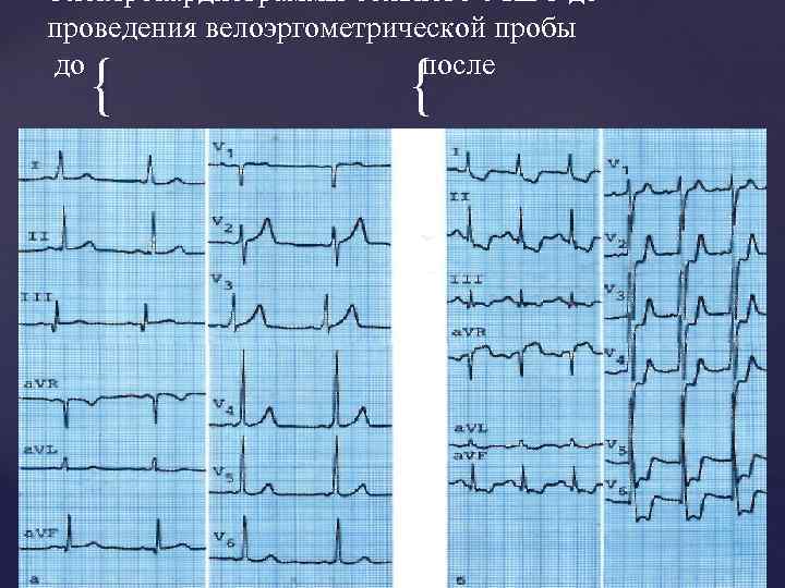 Электрокардиограммы больного с ИБС до проведения велоэргометрической пробы до после { { 