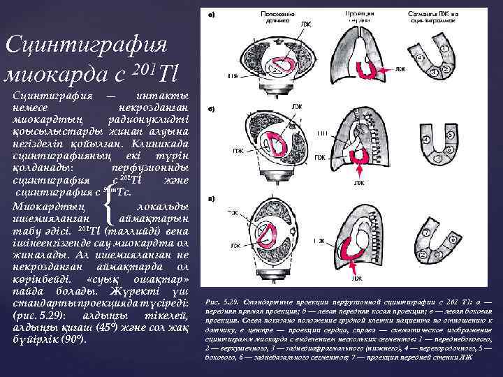 Сцинтиграфия миокарда с 201 Тl Сцинтиграфия — интакты немесе некрозданған миокардтың радионуклидті қоысылыстарды жинап