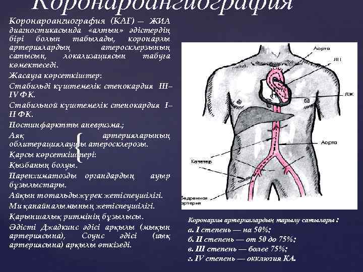 Коронароангиография (КАГ) — ЖИА диагностикасында «алтын» әдістердің бірі болып табылады, коронарлы артериялардың атеросклерзының сатысын,