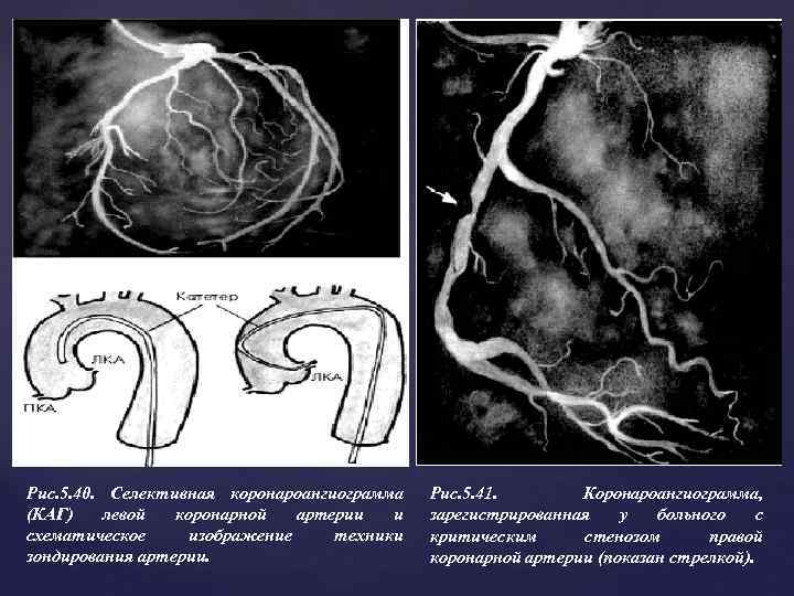 Рис. 5. 40. Селективная коронароангиограмма (КАГ) левой коронарной артерии и схематическое изображение техники зондирования
