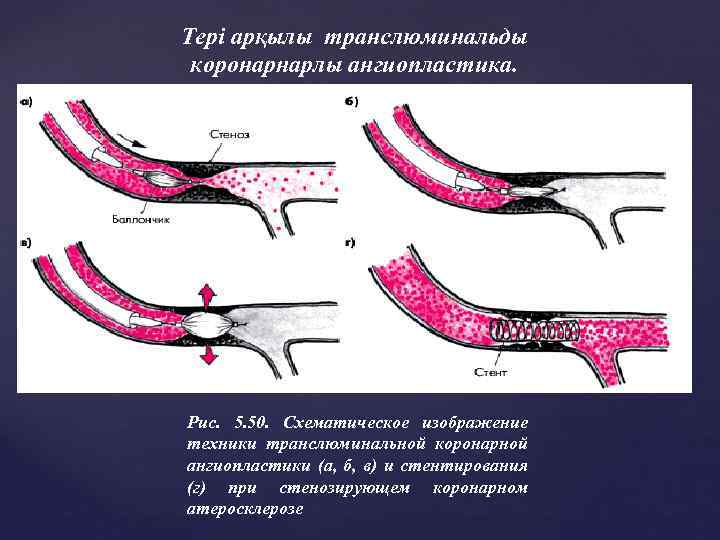 Тері арқылы транслюминальды коронарнарлы ангиопластика. Рис. 5. 50. Схематическое изображение техники транслюминальной коронарной ангиопластики