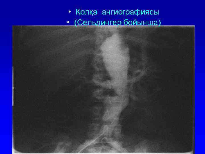  • Қолқа ангиографиясы • (Сельдингер бойынша) 