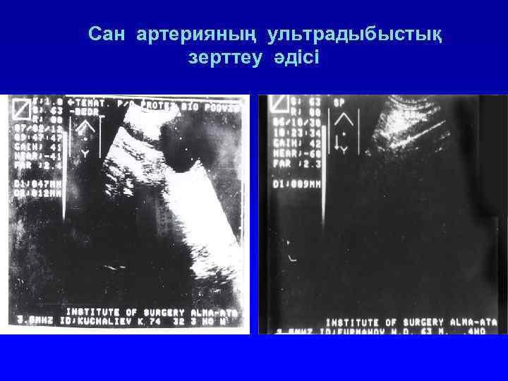 Сан артерияның ультрадыбыстық зерттеу әдісі 