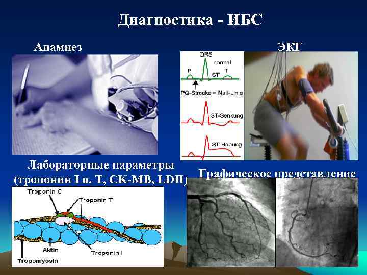 Диагностика - ИБС Анамнез ЭКГ Лабораторные параметры (тропонин I u. T, CK-MB, LDH) Графическое
