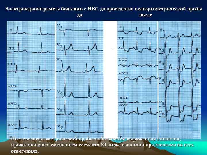 Электрокардиограммы больного с ИБС до проведения велоэргометрической пробы до после После велоэргометрической пробы наблюдается