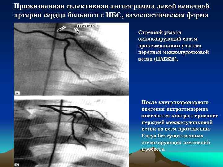 Прижизненная селективная ангиограмма левой венечной артерии сердца больного с ИБС, вазоспастическая форма Стрелкой указан