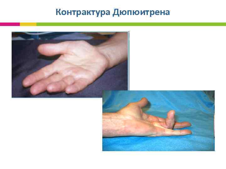 Контрактура Дюпюитрена 