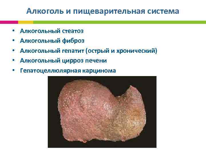 Алкоголь и пищеварительная система • • • Алкогольный стеатоз Алкогольный фиброз Алкогольный гепатит (острый