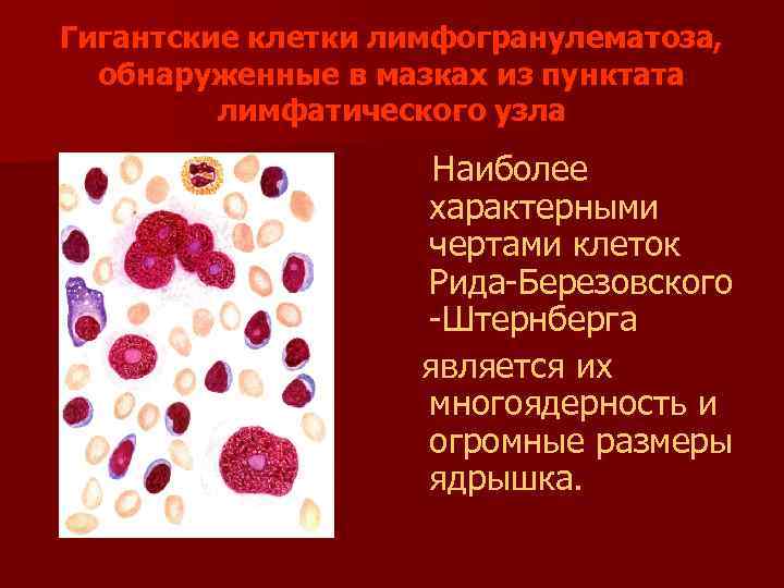 Гигантские клетки лимфогранулематоза, обнаруженные в мазках из пунктата лимфатического узла Наиболее характерными чертами клеток
