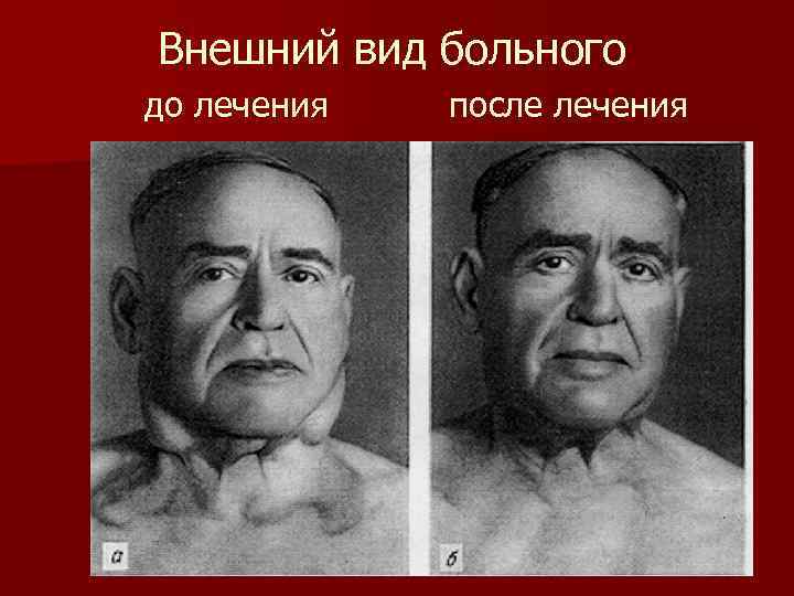 Внешний вид больного до лечения после лечения 