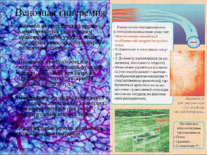 Венозная гиперемия • Типовой патологический процесс, характеризуется увеличением кровенаполнения участка ткани вследствие снижения оттока