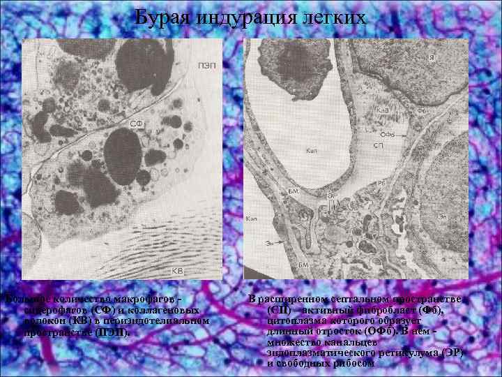 Бурая индурация легких Большое количество макрофагов сидерофагов (СФ) и коллагеновых волокон (КВ) в периэндотелиальном