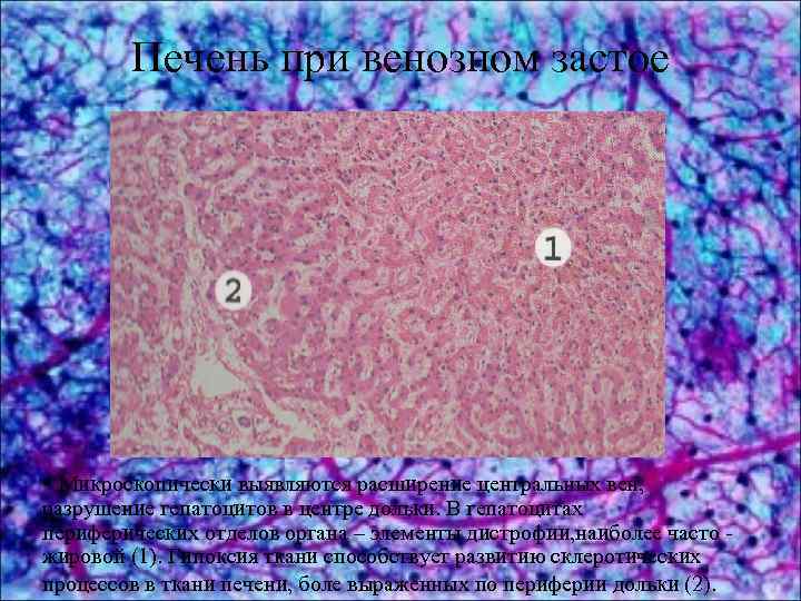 Печень при венозном застое • Микроскопически выявляются расширение центральных вен, разрушение гепатоцитов в центре