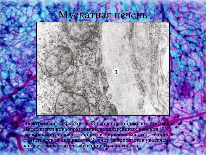 Мускатная печень • Электронная микроскопия. В перисинусоидальном пространстве Диссе пучки новообразованных коллагеновых волокон (1)