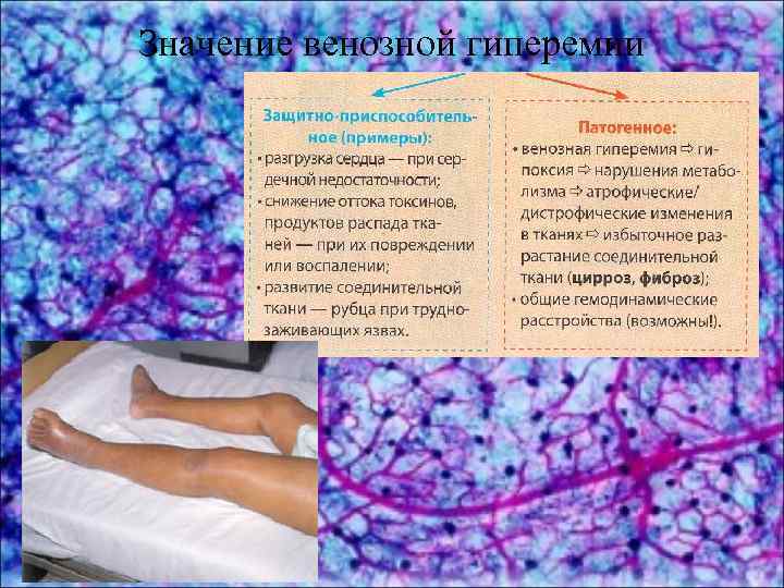 Значение венозной гиперемии 