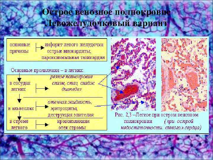 Острое венозное полнокровие Левожелудочковый вариант 