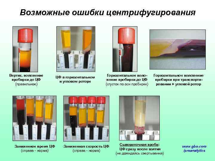 Возможные ошибки центрифугирования Вертик. положение пробирки до ЦФ (правильное) Заниженное время ЦФ (справа -
