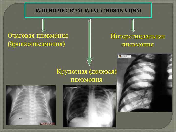 Пневмония очаговая презентация